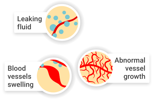 Abnormal Blood Vessels