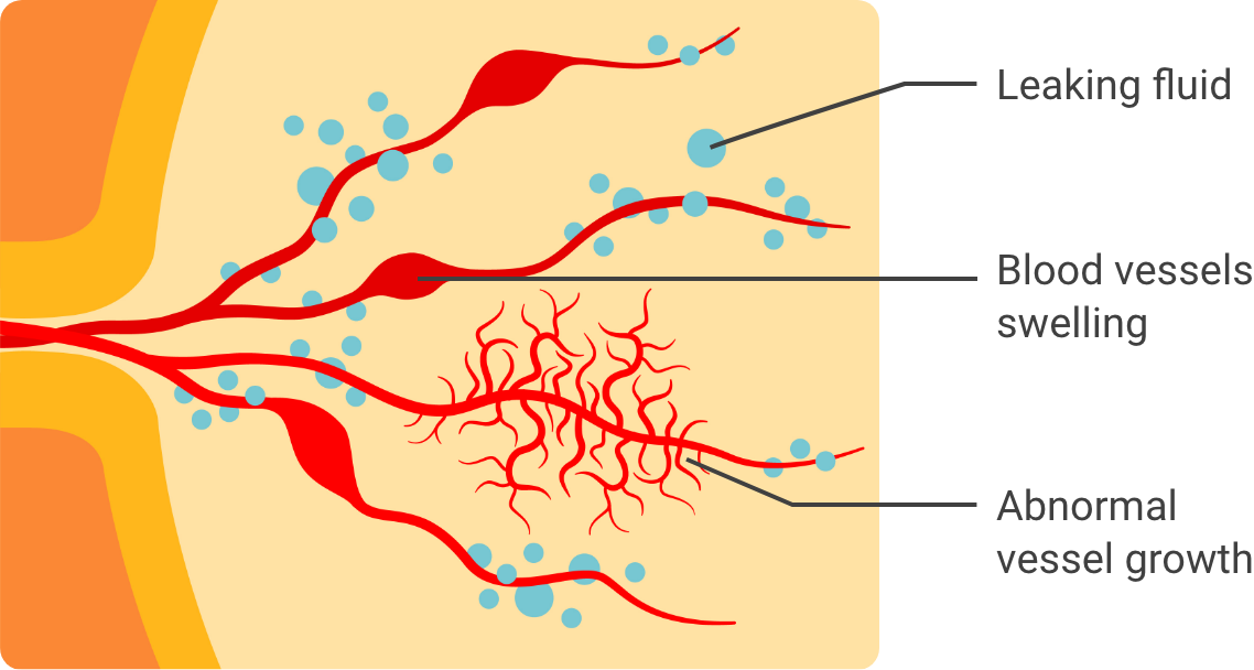 Abnormalities of blood vessels in the retina can include fluid leakage, blood vessel swelling, and abnormal vessel growth.