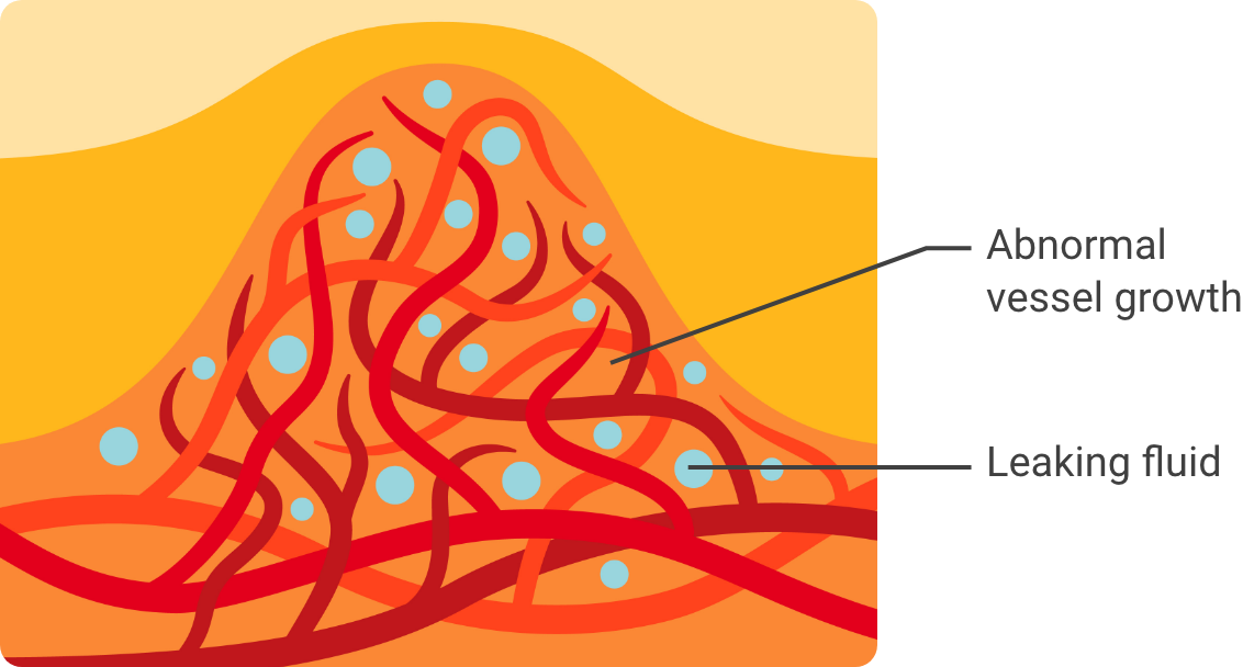 The macula can become swollen due to abnormal vessel growth and leaking fluid.